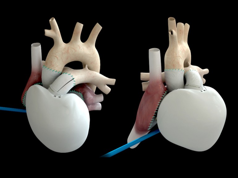 medical bionic implant artificial organs market The global medical bionic implants market is expected to exceed more than usd$ 22 billion by 2022 and 5 global medical bionic implant/artificial organs market, by. medical bionic implant artificial organs market The global medical bionic implants market is expected to exceed more than usd$ 22 billion by 2022 and 5 global medical bionic implant/artificial organs market, by.